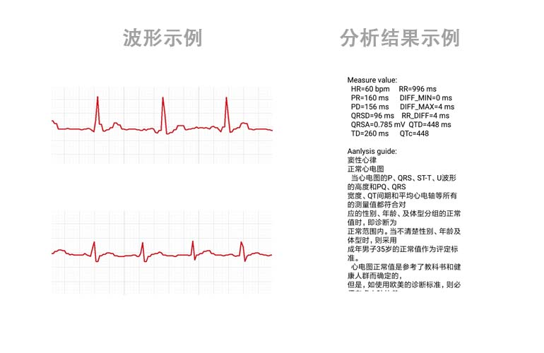 心電數(shù)據(jù)SDK算法庫(kù)----心電芯片、心電手環(huán)芯片、可穿戴心電設(shè)備、智能監(jiān)護(hù)儀